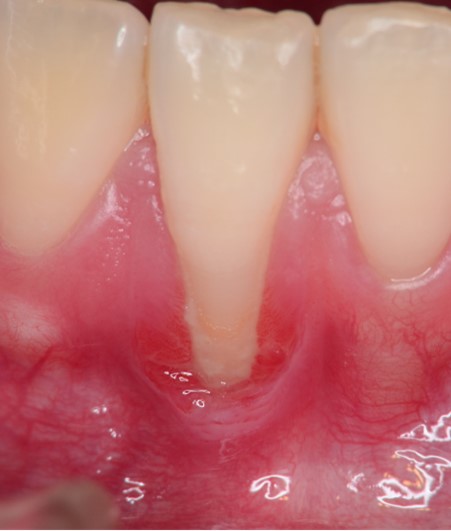 歯肉の退縮例